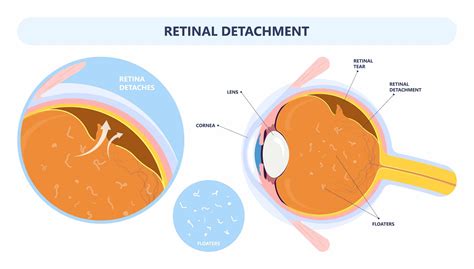 Retinal Detachment - Alaska Retinal Consultants