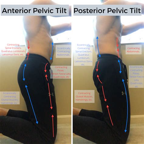 Anterior Pelvic Tilt - A Deep Dive Guide : r/AdvancedPosture