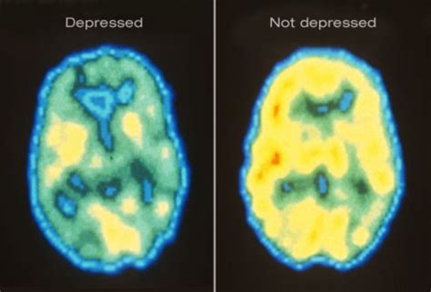Ever Wondered What Causes Depression In Your Brain? There’s A Pattern ...