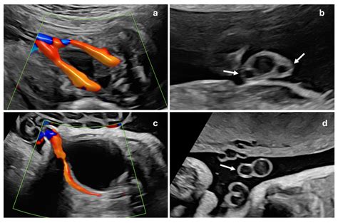 Fetal Isolated Single Umbilical Artery (ISUA) and Its Role as a Marker of Adverse Perinatal Outcomes