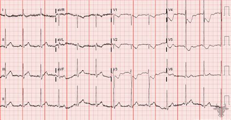 Posterior Myocardial Infarction | ECG Stampede