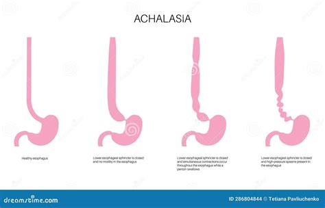 Esophageal Achalasia Wikipedia