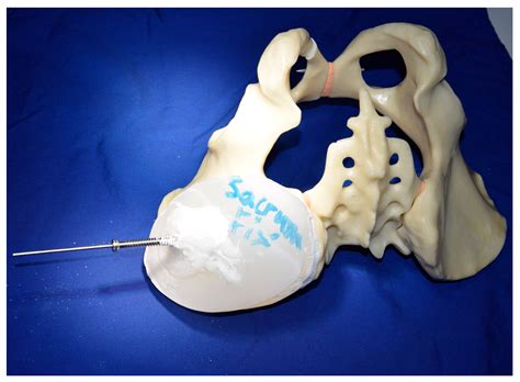 Does Cement Augmentation of the Sacroiliac Screw Lead to Superior ...