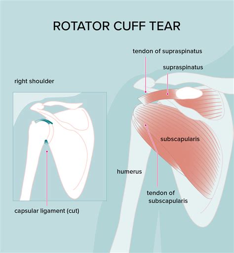 Rotator Cuff Pain Description at Louise Mcmakin blog