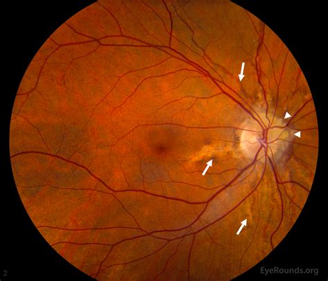 Angioid Streaks and Optic Disc Drusen in Pseudoxanthoma Elasticum : The University of Iowa ...