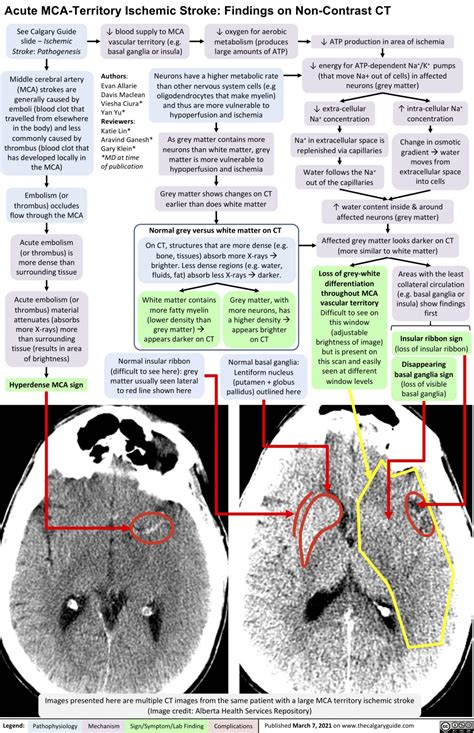 Acute MCA-Territory Ischemic Stroke: Findings on Non-Contrast CT ...