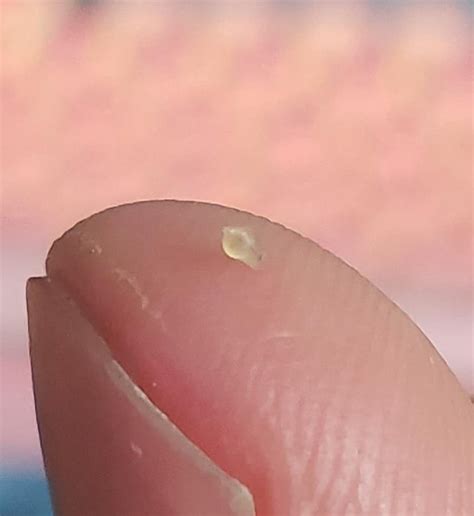 Largest Exploding Cyst 的图像结果