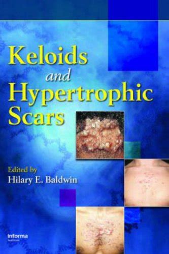 Buy Keloids and Hypertrophic Scars (Basic and Clinical Dermatology ...