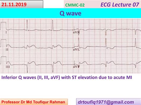 ECG-Q wave | PPT