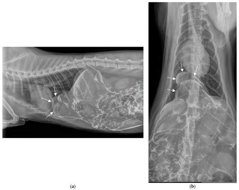 True Diaphragmatic Hernia (Morgagni Hernia) Incidentally Diagnosed with ...