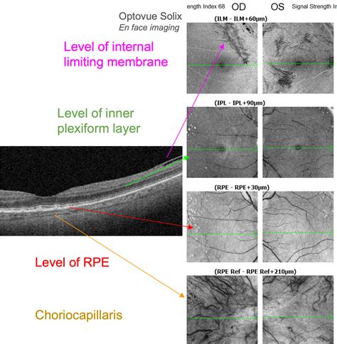 Case #65 - Subretinal Drusenoid Deposits (SDDs) in AMD – Page 20 of 66 ...