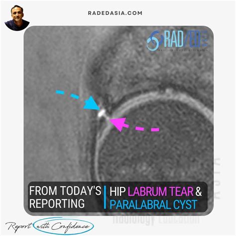 HIP LABRUM ABNORMALITIES ON MRI & CT