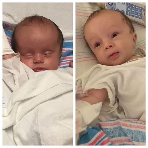 Hydrocephalus Before And After Shunt