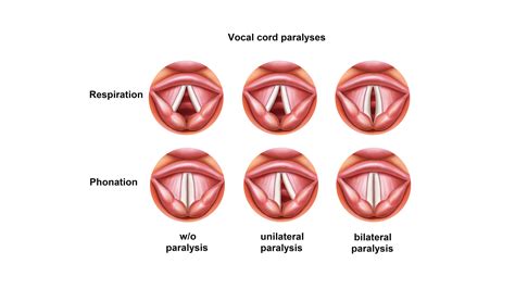 Vocal Cord Paralysis