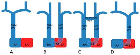 Persistent Left Superior Vena Cava with Absent Right Superior Vena Cava and Discrete Subaortic ...