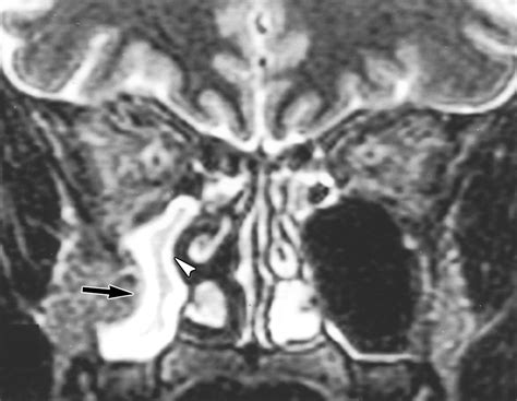 The Silent Sinus Syndrome Clinical and Radiographic Findings | AJR