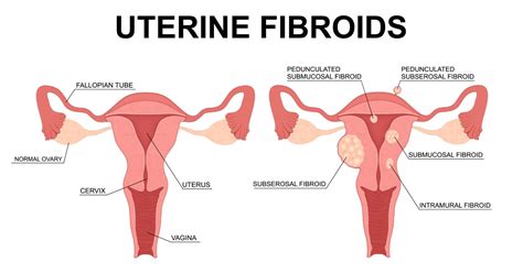 Four Types of Fibroids and Their Location | AFC
