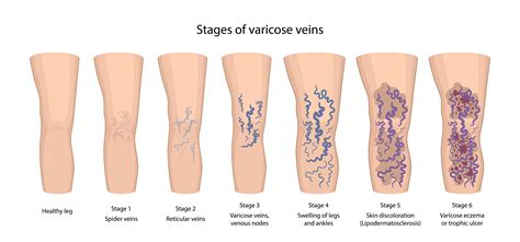 Venous Insufficiency Best Vein Specialists The Vein