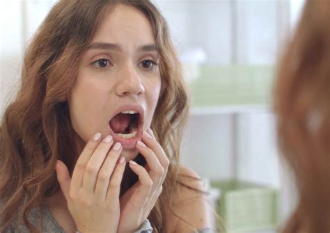 Why is the Roof of My Mouth Peeling?