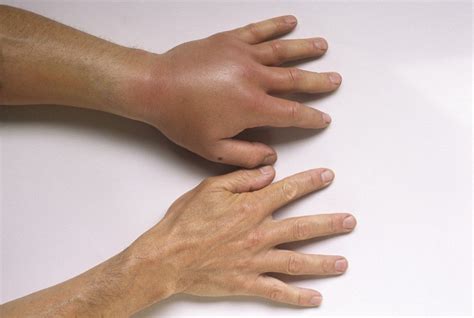Bee, Wasp, Hornet, and Ant Stings - Injuries and Poisoning - Merck Manual Consumer Version