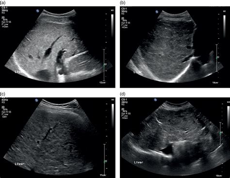 Enlarged Liver Ultrasound