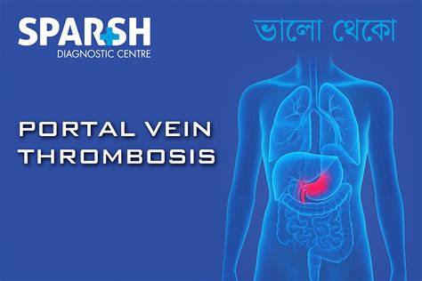 Dengue Shock Syndrome - Sparsh Diagnostic Center