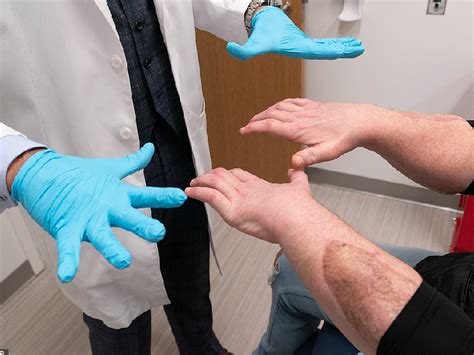 Joe DiMeo; World's First Successful Face Double Hand Transplant In ...