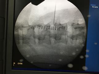 Dr. Partha Pratim Bishnu - Spinal Tumor Surgeon in Kolkata, Spine ...