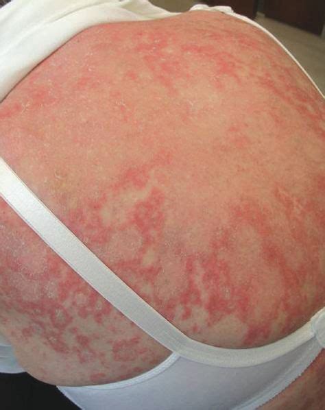 lupus or sjögren's syndrome