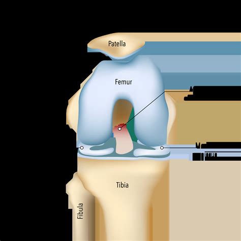ACL Repair Surgery | ACL Rupture & ACL Tear Repair
