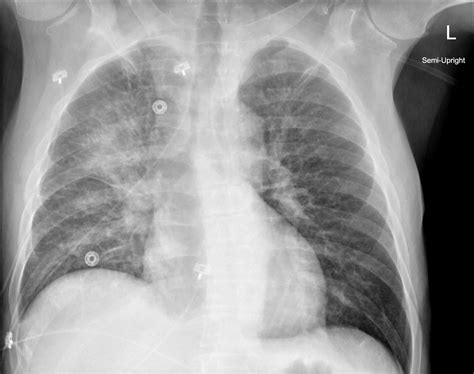 Pulmonary edema, causes, symptoms, diagnosis, treatment & prognosis