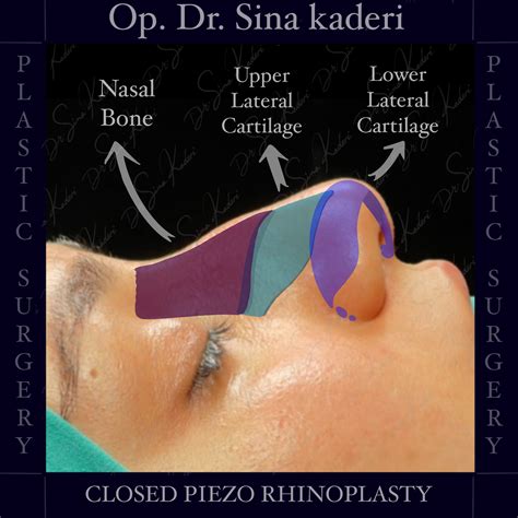 Closed Piezo Rhinoplasty: Natural, Precise and Scarless Nasal Surgery