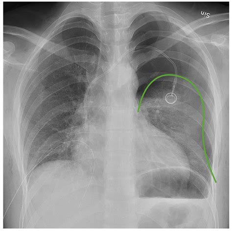 How To Read A Pneumothorax X Ray at Willard Nolen blog