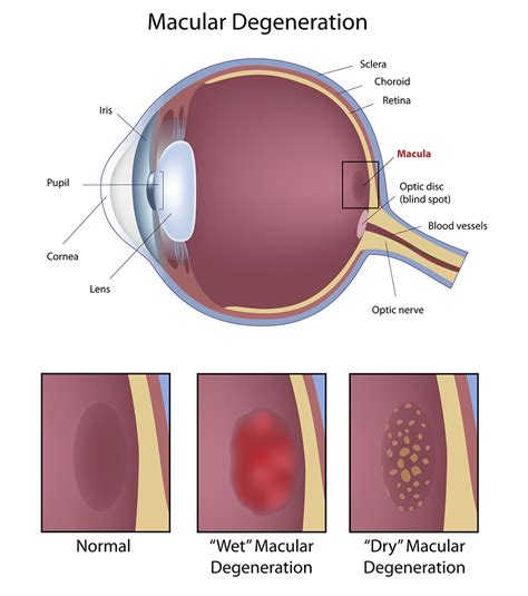 Macular Degeneration Facial Blindness