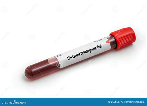 LDH Lactate Dehydrogenase Test Medical Check Up Test Tube with Biological Sample Stock Image ...