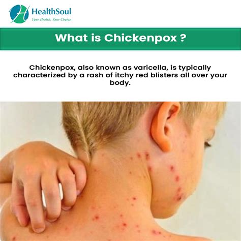First Symptoms Of Chickenpox | Chicken Pox Symptoms and Treatment: What You Need To Know – CYEZ