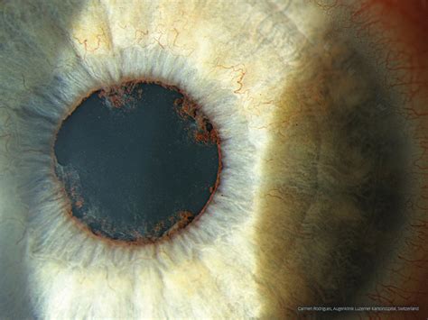 Posterior Synechiae