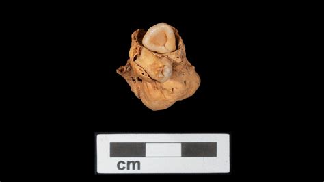 Rare tumor with teeth discovered in Egyptian burial from 3,000 years ago | Live Science