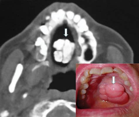 Imaging Torus Lesions of Jaw Bones | Applied Radiology