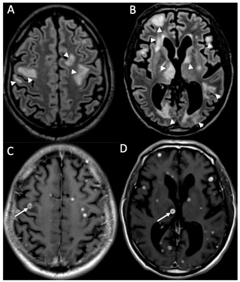 Neuroimaging of the Most Common Meningitis and Encephalitis of Adults: A Narrative Review