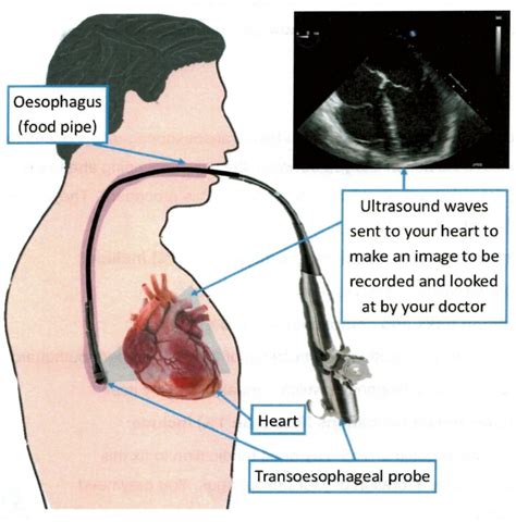 Transoesophageal Echocardiogram (TOE) | Pensinsula Cardiology