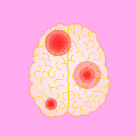 ¿Por qué dan embolias cerebrales?