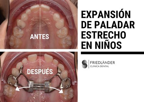 Expansión de paladar estrecho en niños | Clínica Friedlander