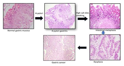 Pathology Outlines - Intestinal metaplasia