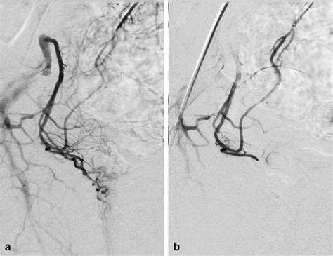 Superior Rectal Artery Embolization for Symptomatic Grades 2 and 3 Hemorrhoidal Disease: 6-Month ...