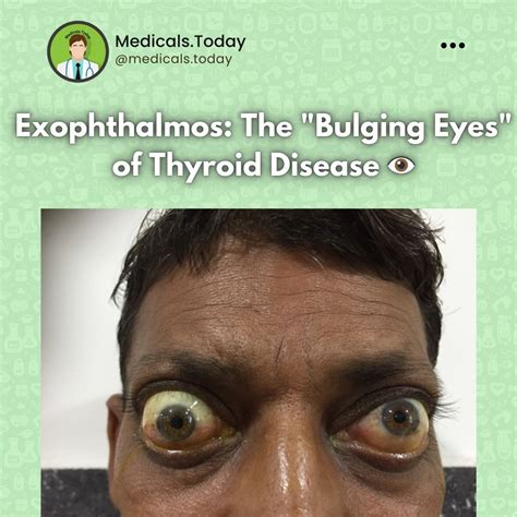 Medicals Today on Instagram: "Exophthalmos, also known as proptosis, is ...
