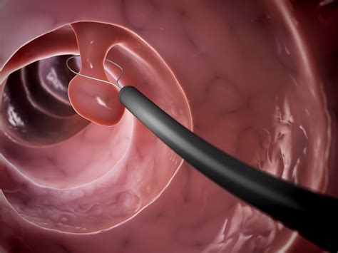 Colonic Polyp | GUTCARE