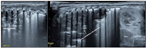 Lung Ultrasound Monitoring of Legionella Ventilator-Associated ...