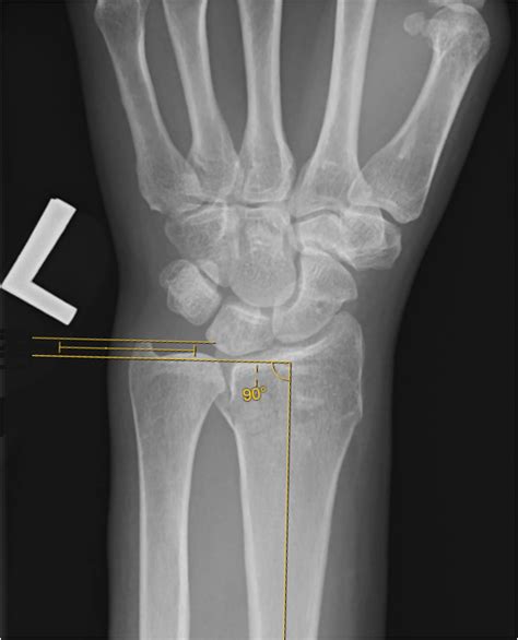 Outcome comparison of operated distal radius fractures in middle-aged ...