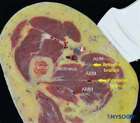 Local Anesthesia Blocks 的图像结果